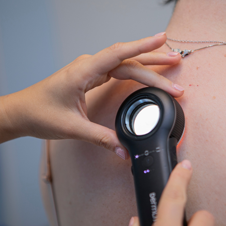 Valutazione dei nevi con dermatoscopio durante la visita dermatologica