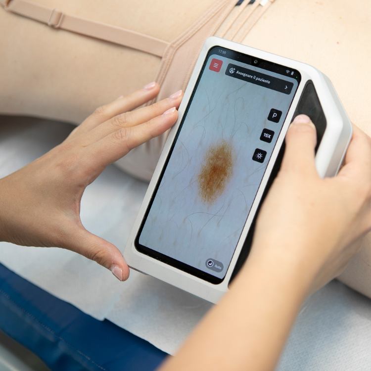 Valutazione dei nevi con dermatoscopio durante la visita dermatologica